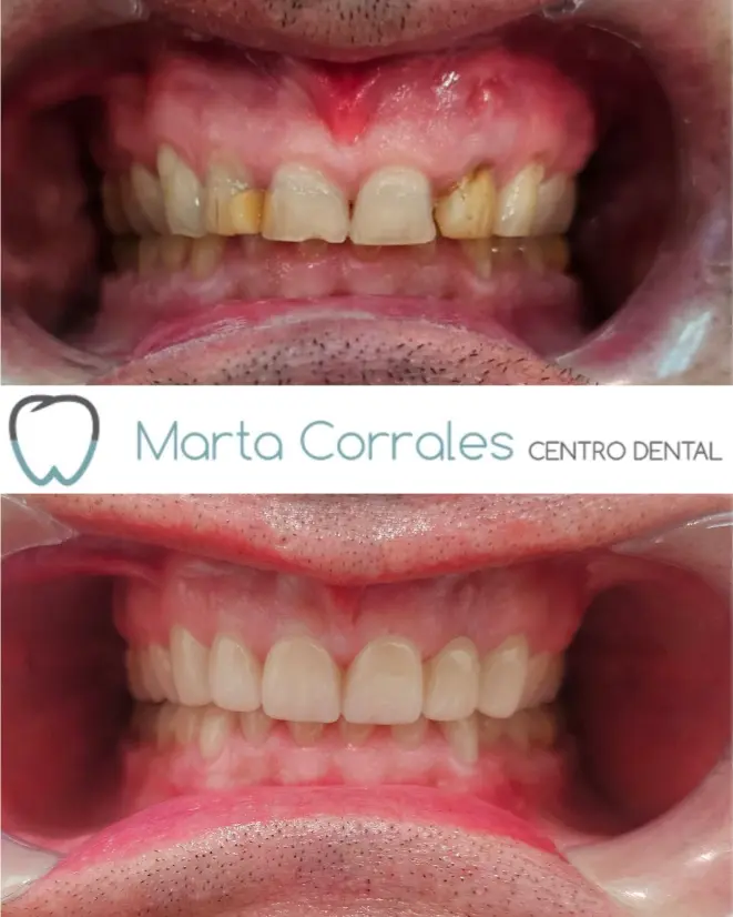 Coronas dentales en Ronda - Clínica dental en Ronda