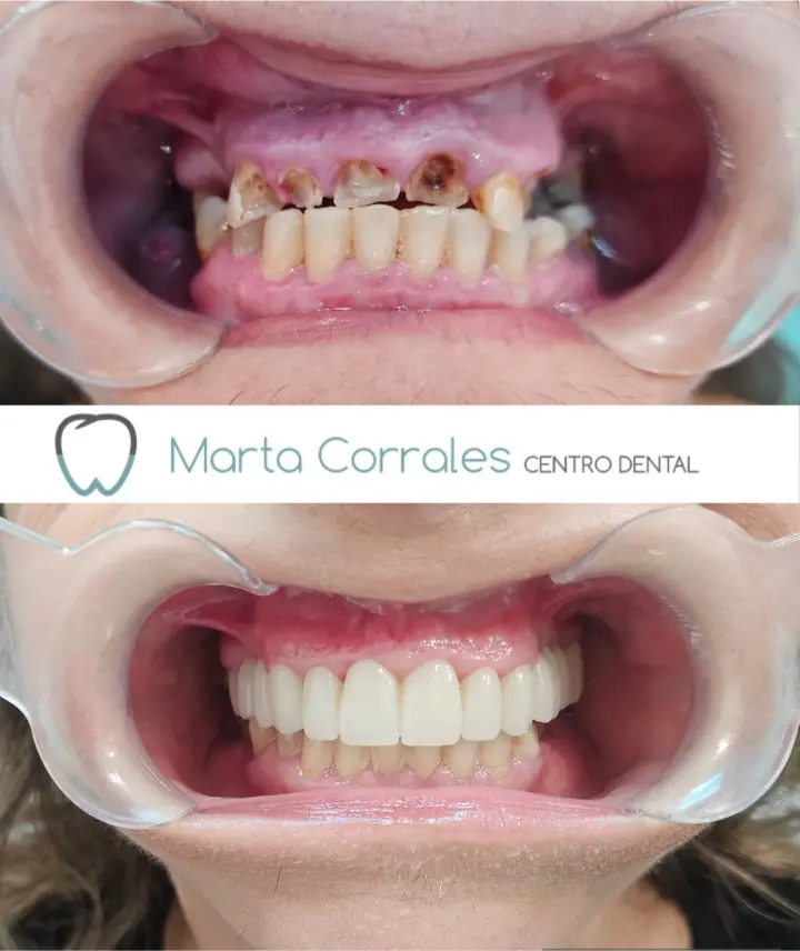 implantes dentales en Ronda - Centro Dental Marta Corrales