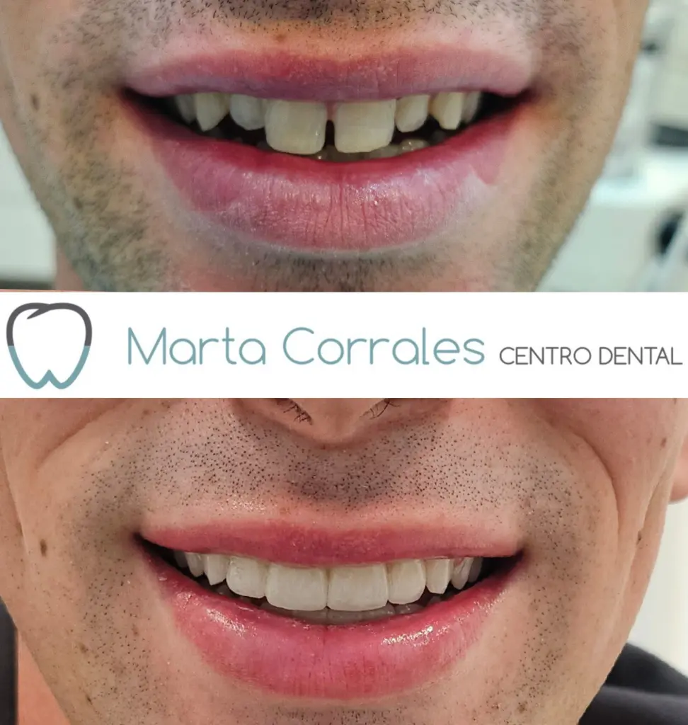 Carillas dentales en Ronda - Clínica dental Marta Corrales